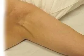 What is this Cord under my arm?!?! Axillary Web Syndrome (AWS)